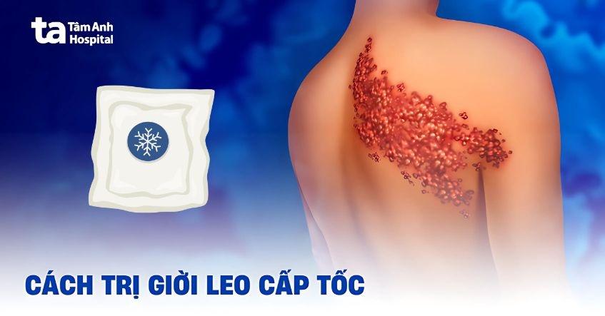 cách trị giời leo hiệu quả an toàn