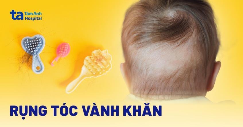 rụng tóc vành khăn