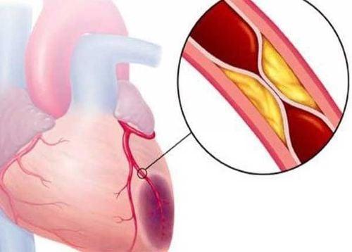 Hội chứng mạch vành cấp xảy ra do sự tích tụ của các chất béo trong và trên các thành của động mạch vành