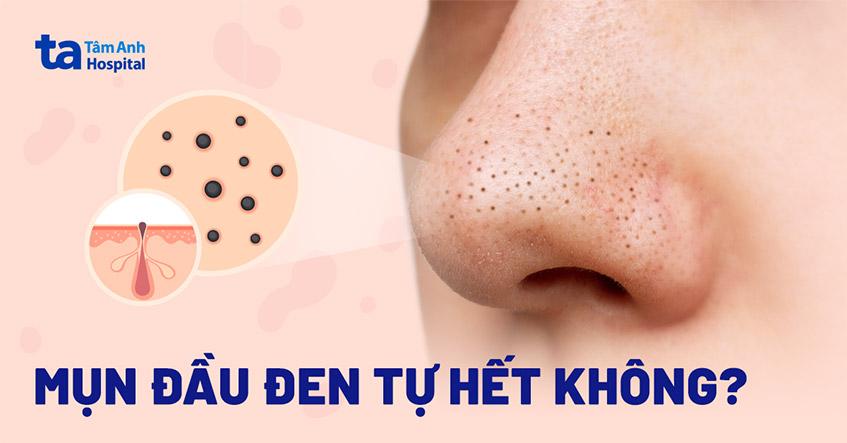 Mụn đầu đen có tự hết được không