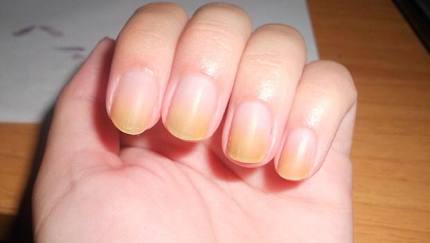 8 dấu hiệu ở móng tay cảnh báo có thể có bệnh nguy hiểm