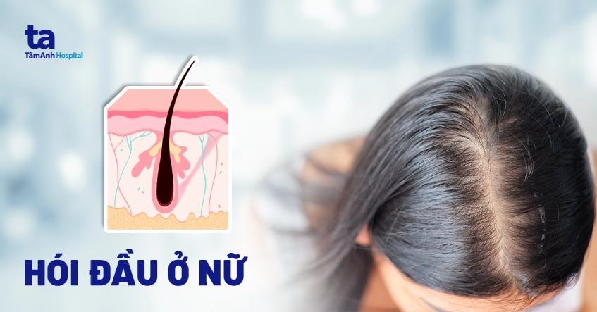 hói đầu ở nữ