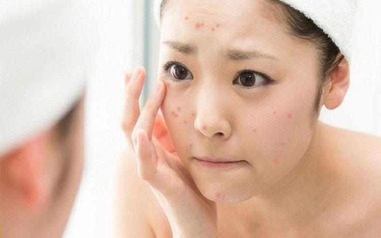 Tại sao nên điều trị mụn bằng Benzoyl là thắc mắc của nhiều người bị mụn