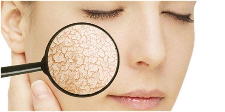 Sừng hóa da là khi tế bào sừng mới được tạo ra di chuyển lên lớp biểu bì và tróc ra khỏi da