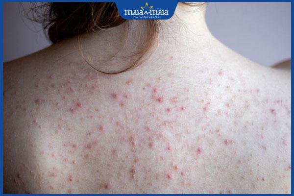 Bị mụn lưng có xăm được không? Khi nào có thể xăm hình? 
